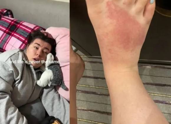 루시 슬로슨(21)이 휴가 중 모기에 물린 뒤 A군 연쇄상구균 감염이 재발하면서 시력이 저하되고 혼수상태까지 겪었다. 더선 캡처