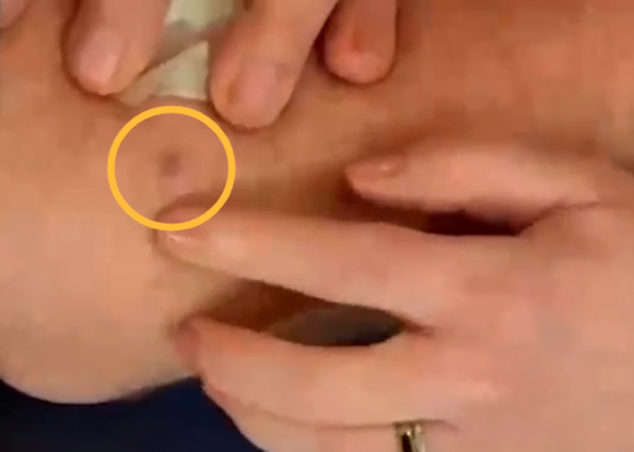 피부과 전문의가 폭스29의 ‘굿 데이 필라델피아’ 진행자인 마이크 제릭의 팔꿈치 부위에 있는 반점(노란색 원)을 가리키고 있다. 폭스29 방송 화면 캡처