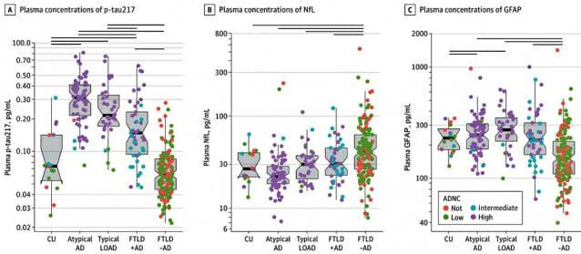 세 가지 바이오마커(p-tau217, NfL, GFAP)를 여러 치매 종류에 적용했을 때 비교 분석 그래프.(제공=강남세브란스병원)