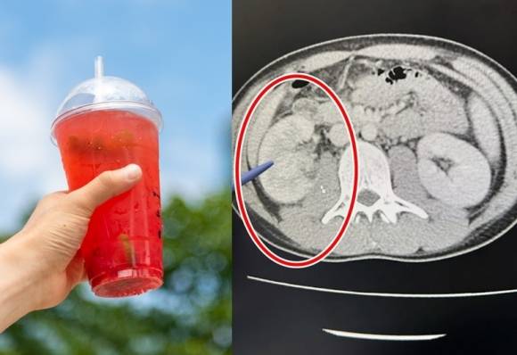 대만의 한 20대 남성이 물 대신 당도 높은 테이크아웃 음료를 즐기고 소변을 참는 습관을 키우다 급성 신우신염 진단을 받았다. 이 남성이 병원에서 컴퓨터단층촬영(CT)을 한 결과 오른쪽 신장에 결석이 생겨 비대해졌다.(오른쪽) 왼쪽은 여름철 즐겨 찾는 시원한 음료. 기사와 관련 없음. 자료 : 아이클릭아트·타이중 리 종합병원