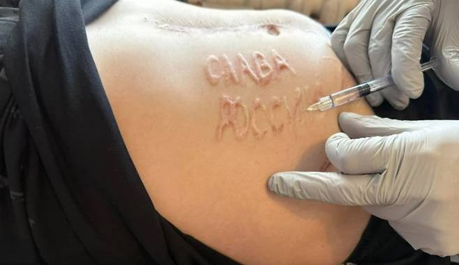 러시아에 포로로 잡혔던 우크라 군인의 배에 새겨진 '러시아에 영광을' 문구. /막심 투르케비치 페이스북