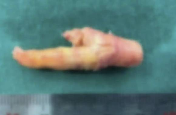 매일 담배 2갑을 피던 중국 남서 류모(55)씨의 경동맥에서 나온 4㎝ 크기의 플라크. 닝보완보 캡처