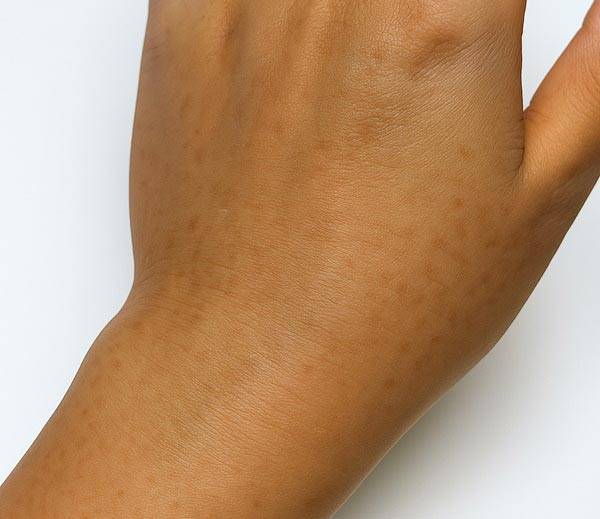 동남아 지역을 다녀온 뒤 손등에 갈색 반점이 생기는 식물성광피부염을 겪는 사람이 많다./사진=AI 생성 이미지