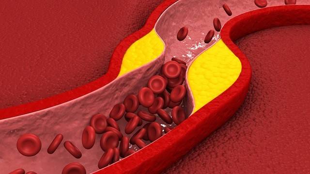 혈관이 막히며 증상이 나타나기 전까지, 이상지질혈증은 별다른 증상이 나타나지 않는다|출처: 게티이미지뱅크