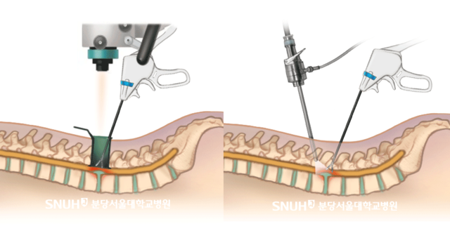 MD수술법(왼쪽부터)과 BED수술법. BED수술법의 절개 범위가 훨씬 적은 것을 알 수 있다. 분당서울대병원.