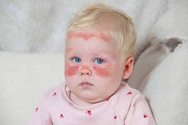 UVA 차단이 제대로 되지 않아 화상입은 레건./사진=데일리 익스프레스