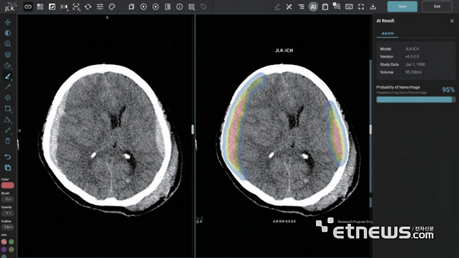 뇌출혈 진단 사진.