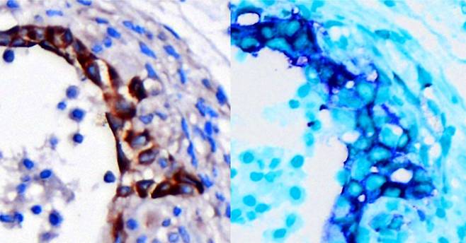 사진 왼쪽은 악성 암 초기 단계에 있는 췌장 세포가 갈색으로 표시되어 있다. 오른쪽은 암 발생 전인 같은 세포가 파란색으로 염색되어 Integrin β3 (ITGB3) 활성화 상태임을 나타낸다. 이 유전자는 췌장암 세포를 암으로 바꾸고 빠르게 자라게 하는 역할을 한다. UCSD 제공.