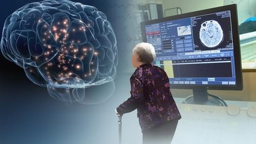 주요 선진국에서 고령화가 가속화되면서 알츠하이머병 치료제 및 관련 기술 개발 움직임이 활발해지고 있다. 연합뉴스