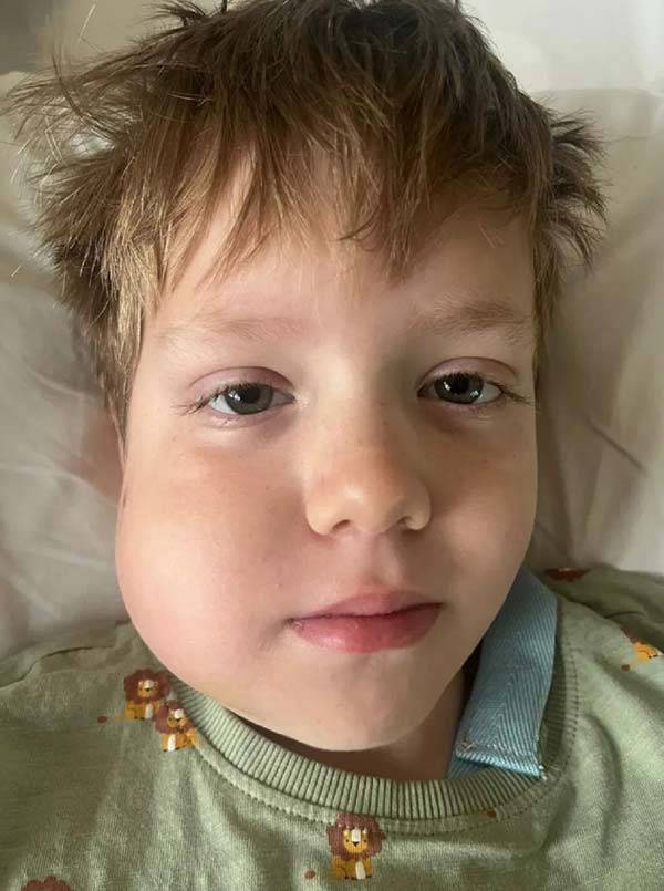 오른쪽 뺨이 부어 치과를 찾은 영국의 7세 남아가 암의 일종인 '버킷 림프종'을 진단받은 사연이 전해졌다./사진=엑스(X) ‘PA Real Life’ 캡처