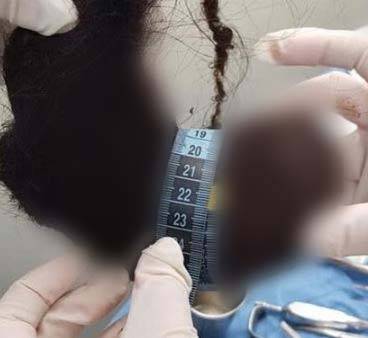 멕시코의 한 세 살배기 아이의 몸에서 거대한 머리카락 덩어리가 나온 충격적인 사연이 공개됐다./사진=니드투노우
