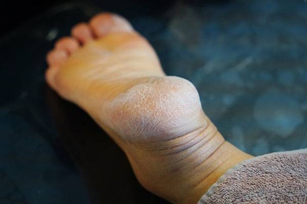 각질 낀 딱딱한 발뒤꿈치는 전염성이 강한 무좀 신호일 수 있다./사진=클립아트코리아