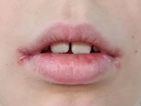 입술은 피부가 얇고 피지선이 없어 쉽게 손상되므로 작은 변화에도 주의를 기울여야 할 부위다./사진=게티이미지뱅크
