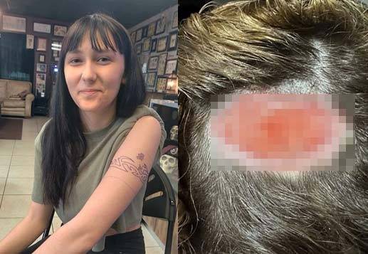 카이리 마틴(18)은 머리를 탈색하는 과정에서 두피에 화학적 화상을 입었다. 오른쪽은 그녀의 두피에 남은 상처./사진=영국 데일리메일 캡처