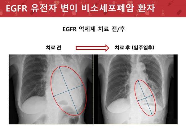 EFGR 변이 표적 치료제 처방 후 종양이 작아진 모습./사진=헬스조선 DB