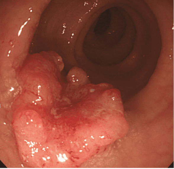 대장내시경으로 발견된 대장암의 모습