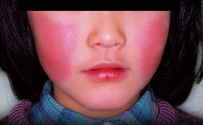 일본 오키나와에서 볼이 빨갛게 변하는 이른바 '사과병'이 유행하고 있어 현지 보건 당국이 경보를 발령했다./사진=오키나와TV 보도화면 갈무리