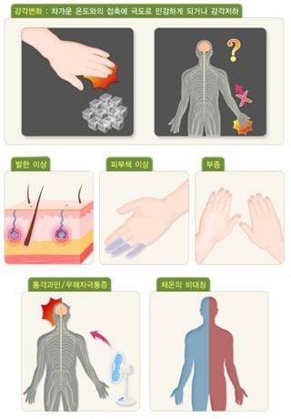복합부위통증증후군 증상은 통증 외에도 감각의 이상 변화와 피부 변화, 발한 이상 등 다양한 형태로 나타날 수 있다. 보건복지부 제공