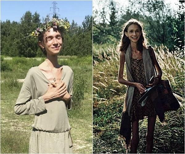 폴란드 출신인 카롤리나 크시자크(27)는 생과일만 섭취하는 극단적인 식단인 ‘과일주의(fruitarian)’를 고수하다 결국 숨졌다. 사망 당시 체중은 약 22㎏에 불과했다. 카롤리나 크시자크 인스타그램(@carolina.mariie) 캡처