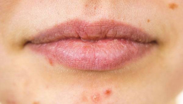 입술은 각질층이 얇고 피지선이 거의 없어 외부 자극에 특히 민감하다. 립 제품을 쓸 때 피부 반응을 관찰하고 이상이 생기면 즉시 사용을 중단해야 한다./사진=클립아트코리아