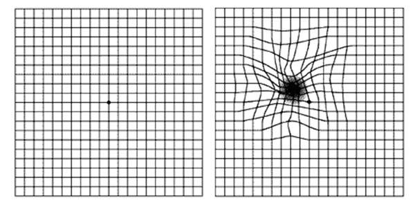 암슬러 격자 자가진단 시 선이 휘어져 보이거나 중심부위 암점 등의 증상이 나타나면 황반변성을 의심해볼 수 있다./사진=김안과병원