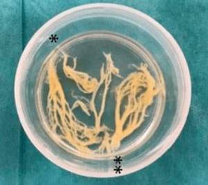 호흡곤란으로 중환자실에 이송된 3세 남아의 기관지에서 나뭇가지처럼 굳은 가래 덩어리가 발견됐다./사진=큐레우스