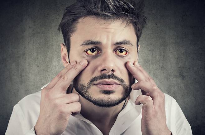 눈이 노랗게 변하면 황달을 의심해 볼 수 있다. 황달은 담즙의 분비와 배출이 원활하지 못할 때 일어난다. 사진=게티이미지뱅크