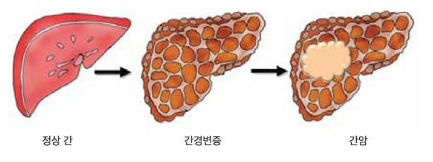 간암 진행 과정(출처: 대한간암학회)