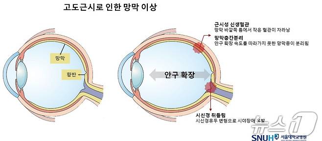 고도 근시로 인한 망막 이상.(서울대병원 제공)