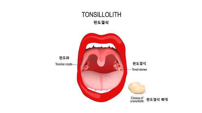 편도결석 | 출처: 게티이지미뱅크
