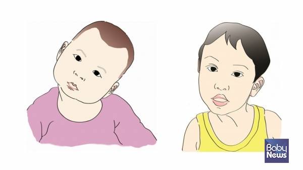 아기 목이 기운다면 단순한 습관이 아니라 '사경'이라는 의학적 문제의 신호일 수 있다. ⓒ임신영