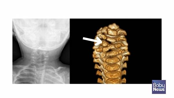 목뼈의 반쪽 척추. ⓒ임신영