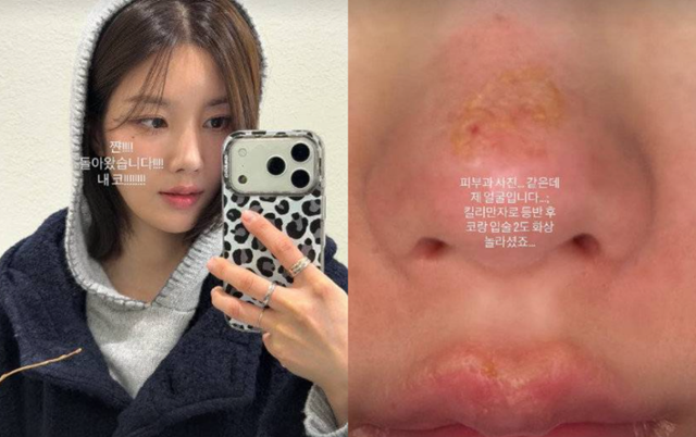 가수 권은비가 얼굴 화상을 입은 근황을 공개했다. 권은비 SNS