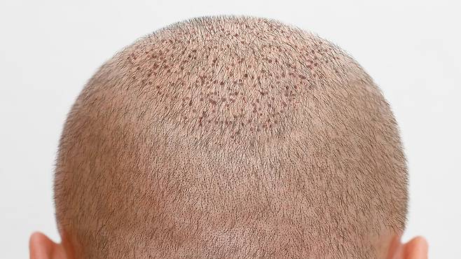 비절개식은 점 형태의 미세한 흔적이 남고 시간이 지나면 거의 사라진다|출처: 게티이미지뱅크