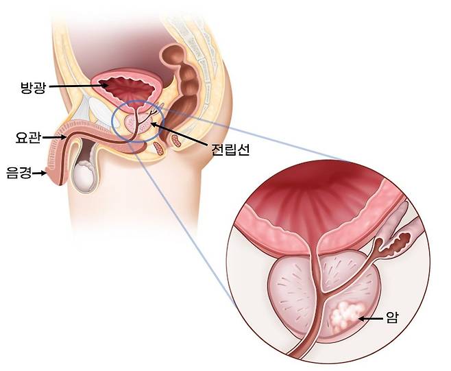 전립선암 모식도. 자료 서울아산병원