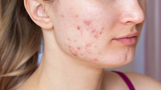 모공 속 피지 분비 환경이 개선되지 않으면 염증성 여드름이 반복적으로 재발할 수 있다|출처: 게티이미지뱅크