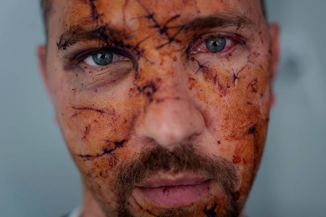 러시아군의 우크라이나 키이우 주택가 공습으로 다친 코스티안틴 비체크의 얼굴에 여러 군데 상처가 나 있다. 2025.4.25 키이우 AP 연합뉴스