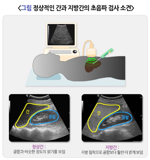정상 간과 지방간의 초음파 검사 소견. 사진 제공=국가건강정보포털