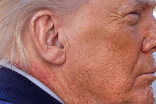 도널드 트럼프 미국 대통령 목에 있는 붉은 반점. AP, 연합뉴스