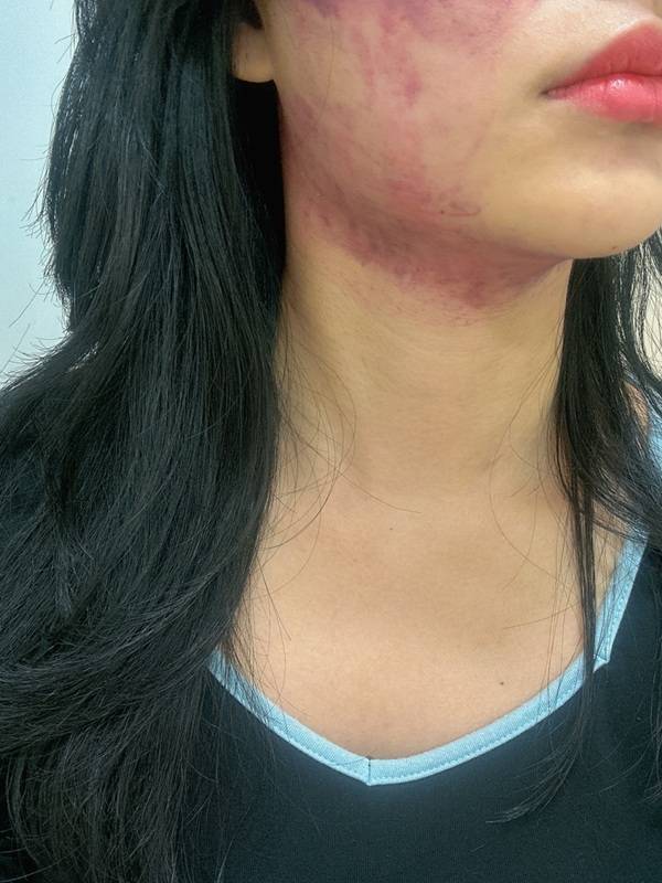 A photo shared by a woman following an InMode laser lifting treatment, showing noticeable redness on her face. (Naver Blog, potentialps)