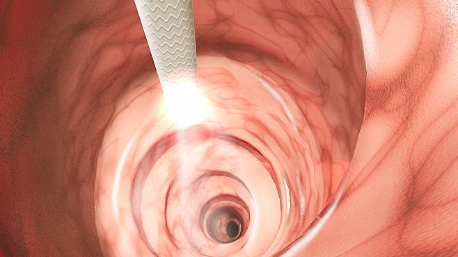 대장암은 1기에 발견할 경우 5년 생존율이 90% 이상에 달할 정도로 예후가 양호한 편이다|출처: 게티이미지뱅크