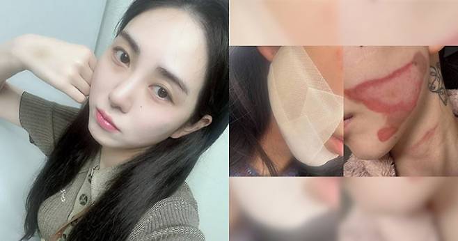 그룹 AOA 출신 권민아. 피부과 시술 중 입은 화상. 권민아 SNS 갈무리