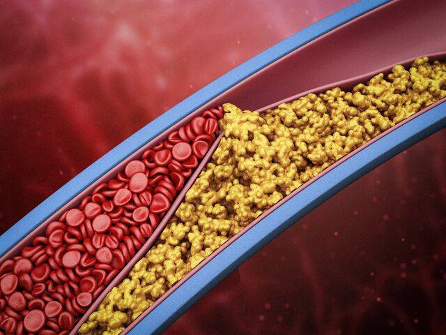 LDL콜레스테롤을 낮추니 심혈관 관련 질환 발생도 30% 이상 줄어들었다는 국내 의료진의 연구 결과가 나왔다. 클립아트코리아