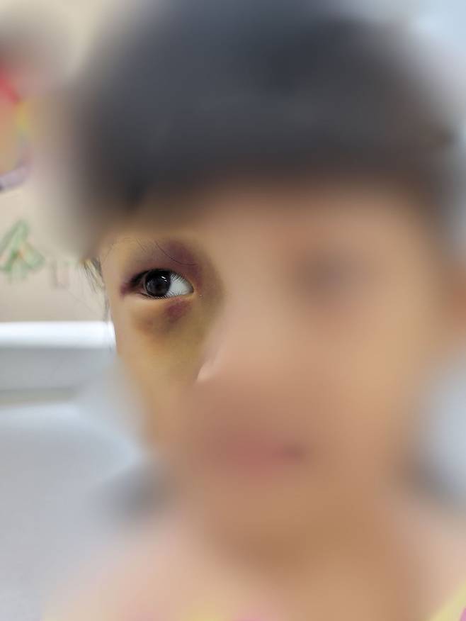 서윤(가명)이 눈에 생긴 멍. 중앙포토