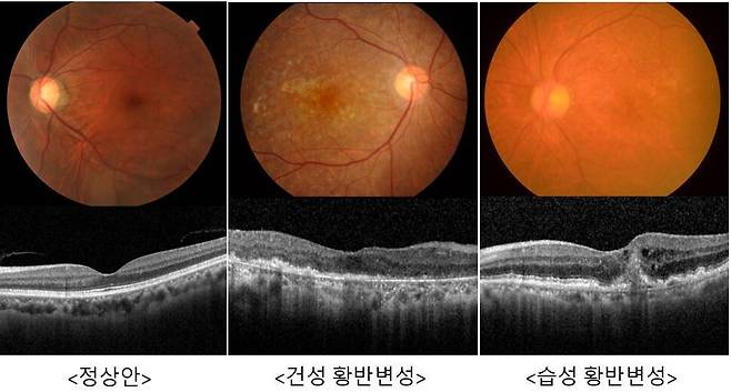 노인성 황반변성은 ‘건성’과 ‘습성’으로 구분된다. 건성은 초기에 별다른 증상이 없거나 중심 시야가 미미하게 흐려지는 정도로 시작되지만, 병이 진행돼 비정상적인 신생 혈관이 발생하면 ‘습성’으로 이행된다. 습성 단계에 접어들면 욕실 타일, 건물 외곽선, 창틀 같은 직선이 휘어져 보이는 ‘변시증’이 나타난다. 세브란스병원 제공