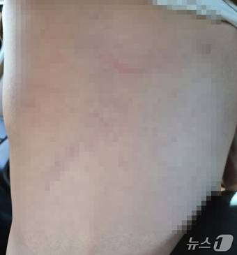 대구 달서구 장애 전담 어린이집 아동학대 피해 아동의 등 사진(독자 제공)