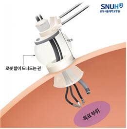 보조 장치를 활용해 로봇 팔이 드나드는 관을 피부 표면에서 약 5cm 위로 띄워 고정했다.