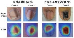 흑색조갑증에 비해 손발톱 흑색종은 빠르게 넓어지거나 진해지는 경우가 많으며 손톱 주변의 피부까지 퍼지는 양상을 보인다. 아래쪽 사진들은 AI가 두 가지를 구분하는 데에 중요한 부분을 활성화(Class Activation Map)한 모습을 보여주고 있다. (세브란스병원 제공)
