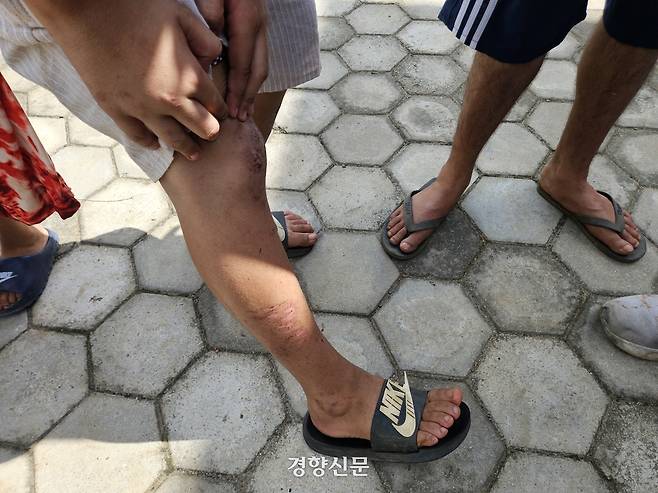31일(현지시간) 네팔 누와코트 게르쿠따르 마을 대피소에 머물고 있는 소스틱 포우델(14)이 대홍수에 휩쓸렸을 당시 입은 다리의 상처들을 보여주고 있다. 박민규 기자