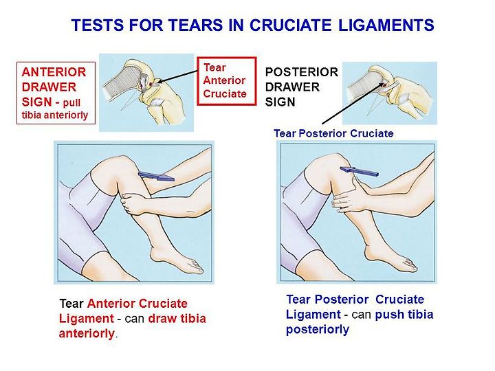 무릎관절의 앞당김검사 Anterior Drawer Test